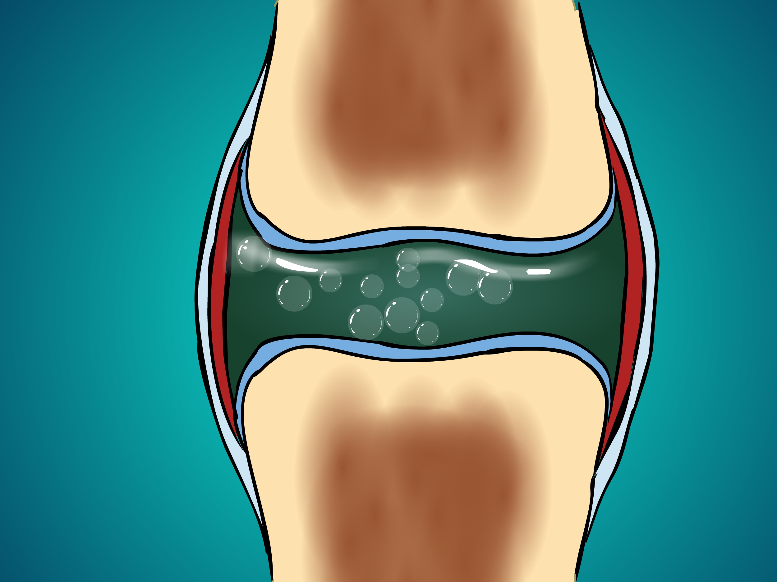 Synovial-fluid-cavitation.jpg