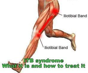 ITB Syndrome: What causes it and how can you fix it?