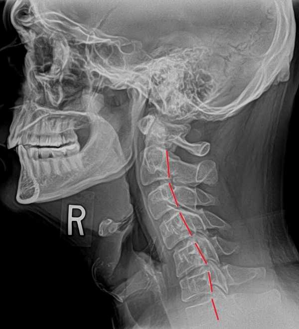 What To Expect For Your First Treatment Cascade Chiropractic And Wellness