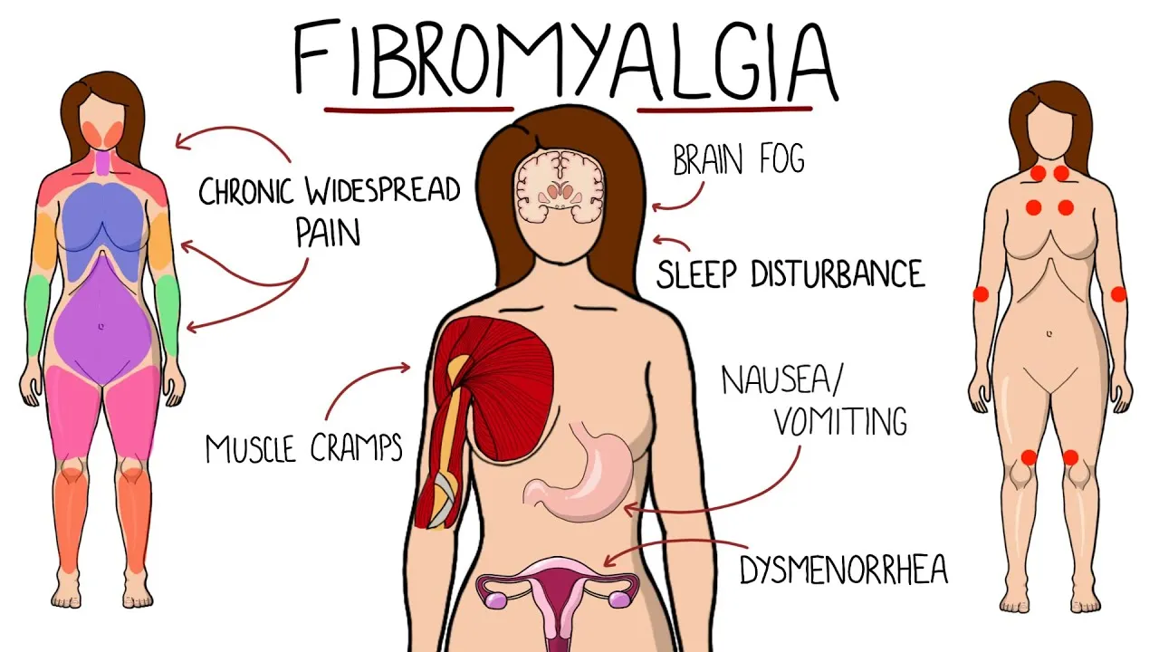 map of fibromyalgia symptoms Portland